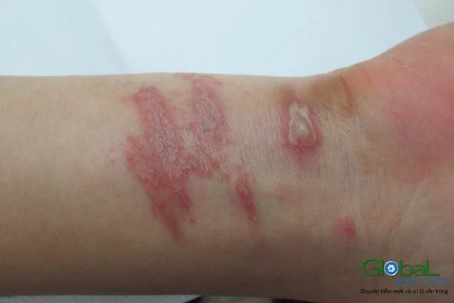 Vì sao công nhân ca đêm bị muỗi đốt nhiều?