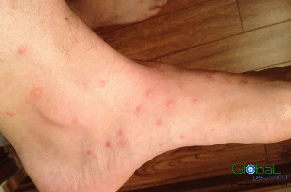Nhiều nốt đỏ nhỏ trên bàn chân và cổ chân người
