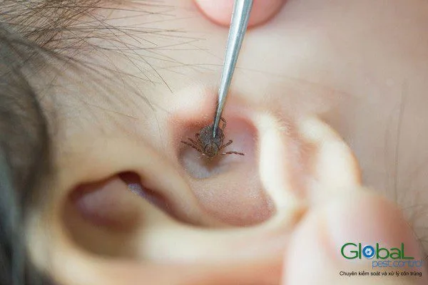 Nhíp gắp con ve bám trong vành tai người